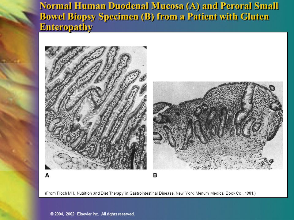 Normal Human Duodenal Mucosa (A) and Peroral Small Bowel Biopsy Specimen (B) from a Patient with Gluten Enteropathy