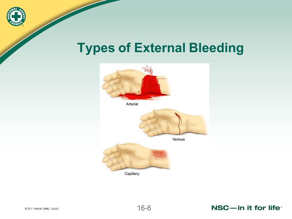 Types of External Bleeding