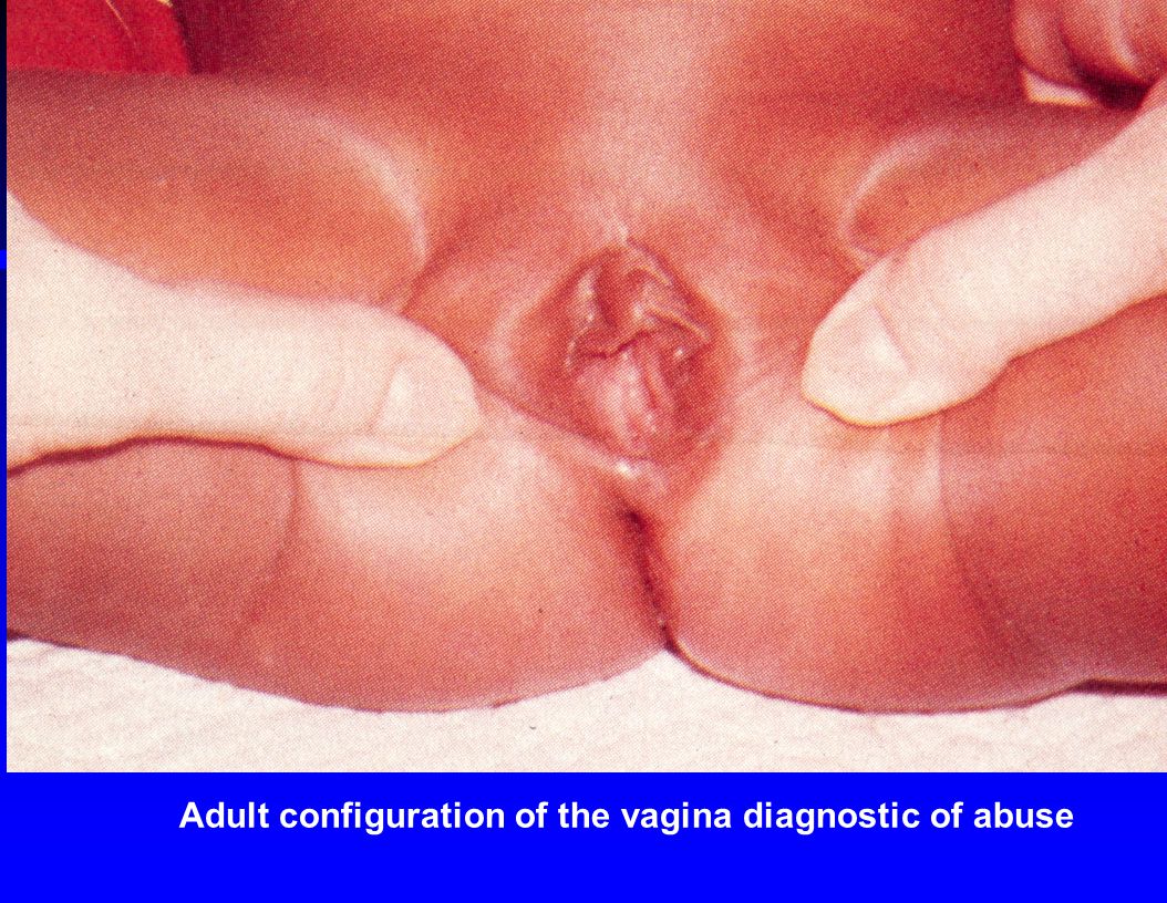 Vaginal abnormalities
