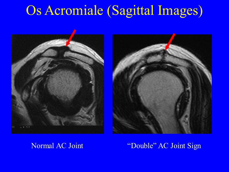 acromion types mri