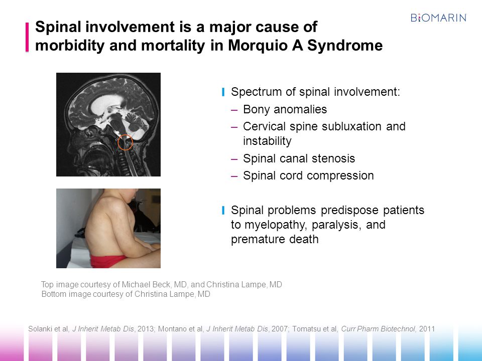 Spinal involvement is a major cause of morbidity and mortality in Morquio A Syndrome