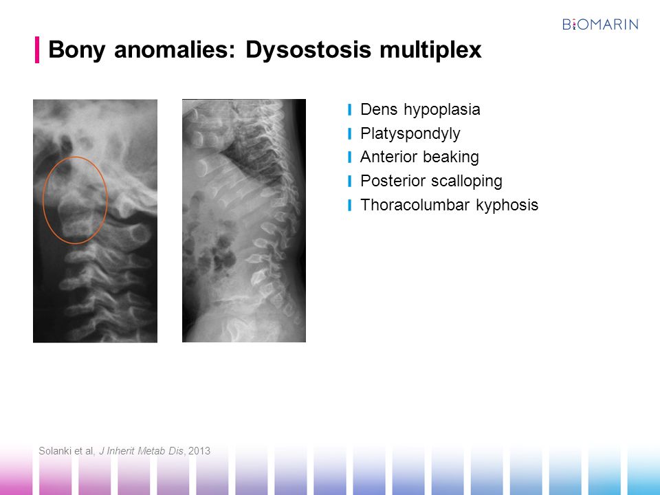 Bony anomalies: Dysostosis multiplex