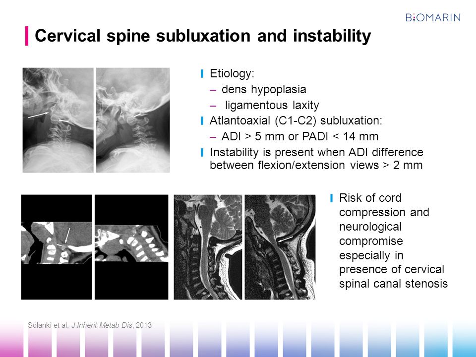 Cervical spine subluxation and instability