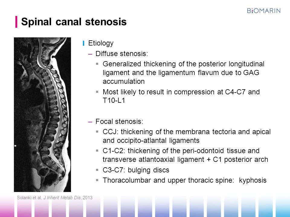 Spinal canal stenosis Etiology Diffuse stenosis: