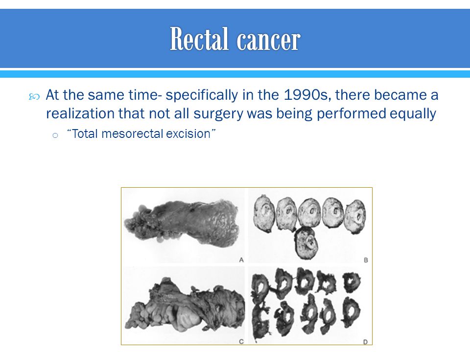Rectal cancer At the same time- specifically in the 1990s, there became a realization that not all surgery was being performed equally.