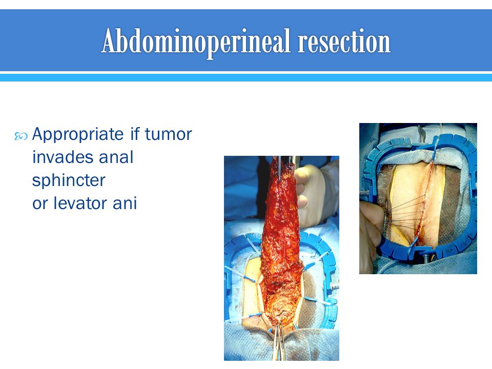 Abdominoperineal resection