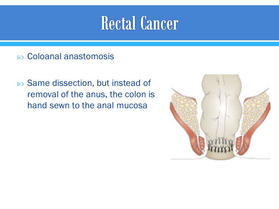 Rectal Cancer Coloanal anastomosis