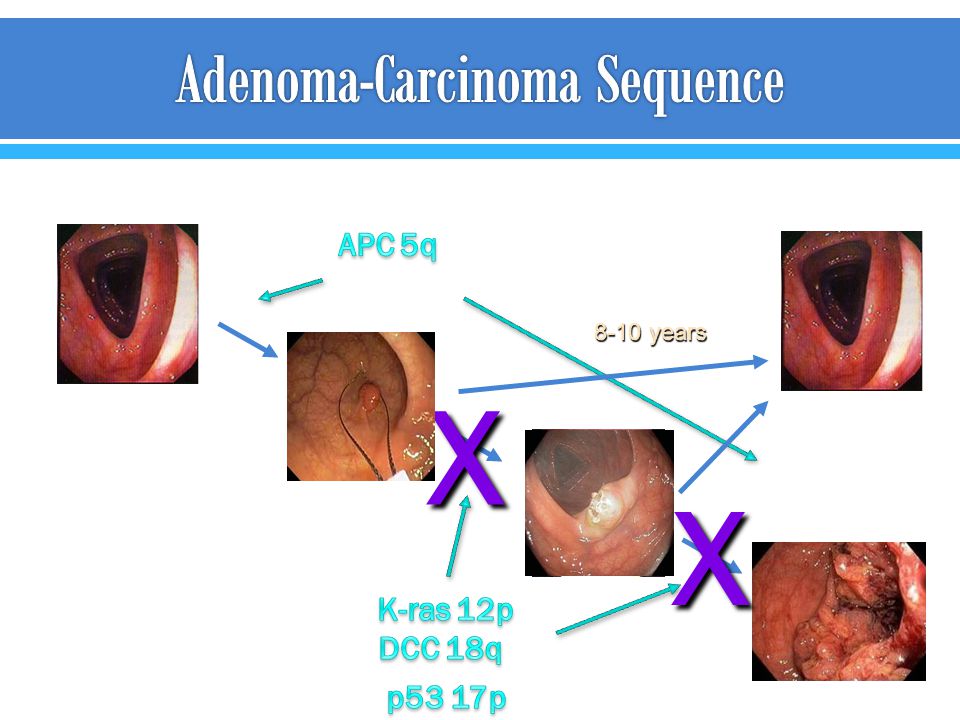 Adenoma-Carcinoma Sequence