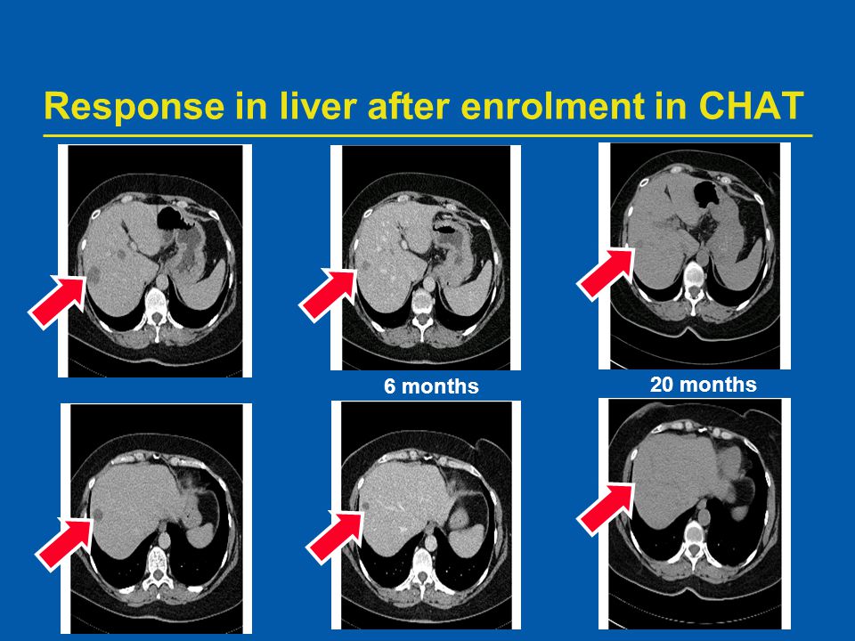 Response in liver after enrolment in CHAT