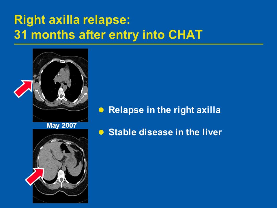 Right axilla relapse: 31 months after entry into CHAT