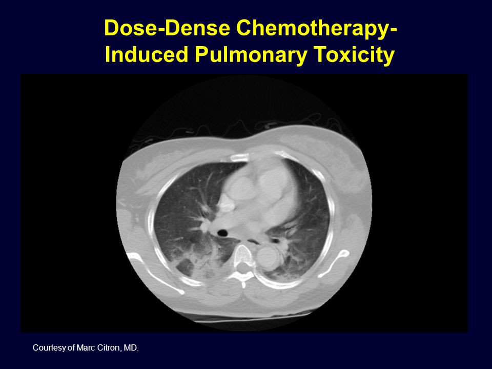 Dose-Dense Chemotherapy-Induced Pulmonary Toxicity