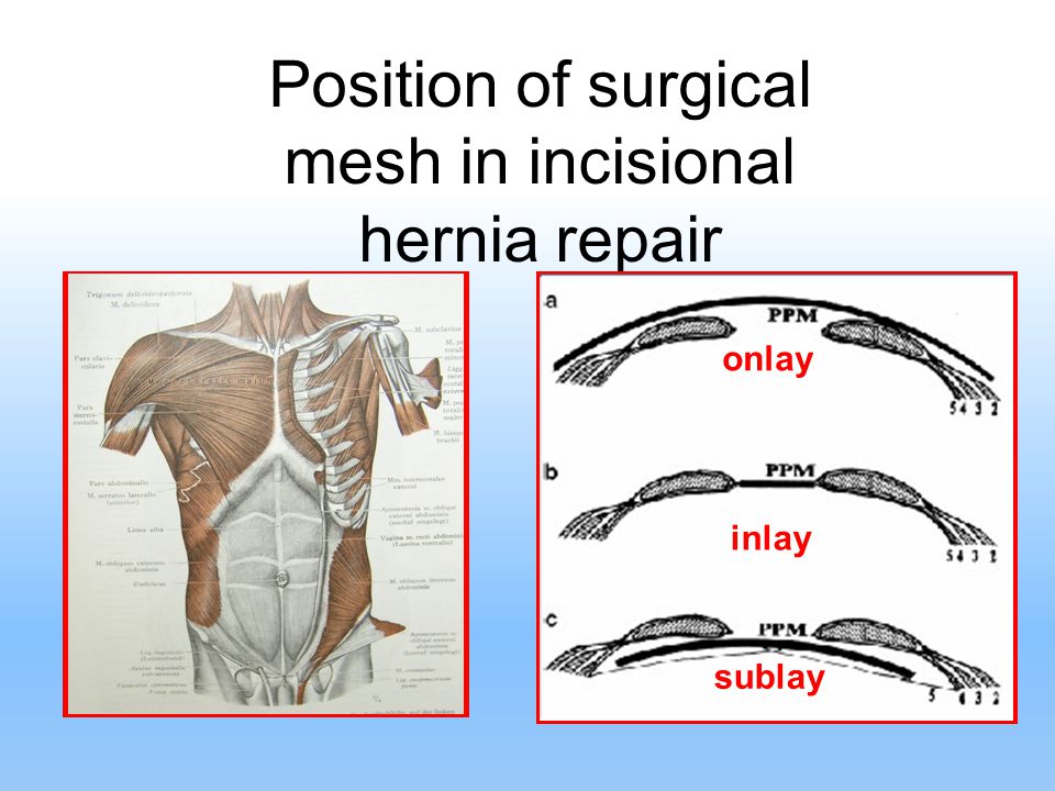 ABDOMINAL HERNIAS AND SURGICAL MESHES - ppt video online download