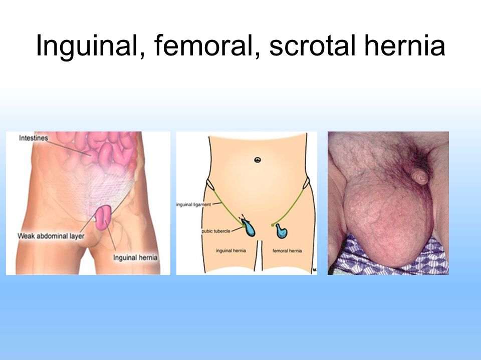 Inguinal, femoral, scrotal hernia.