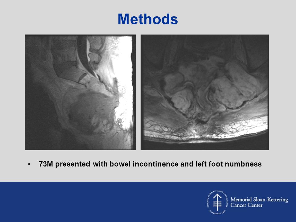 Methods 73M presented with bowel incontinence and left foot numbness