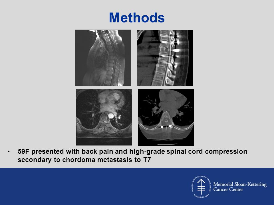 Methods 59F presented with back pain and high-grade spinal cord compression secondary to chordoma metastasis to T7.