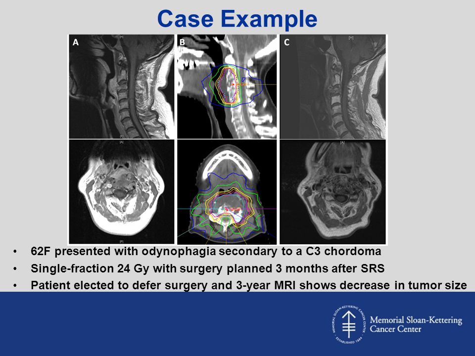 Case Example 62F presented with odynophagia secondary to a C3 chordoma
