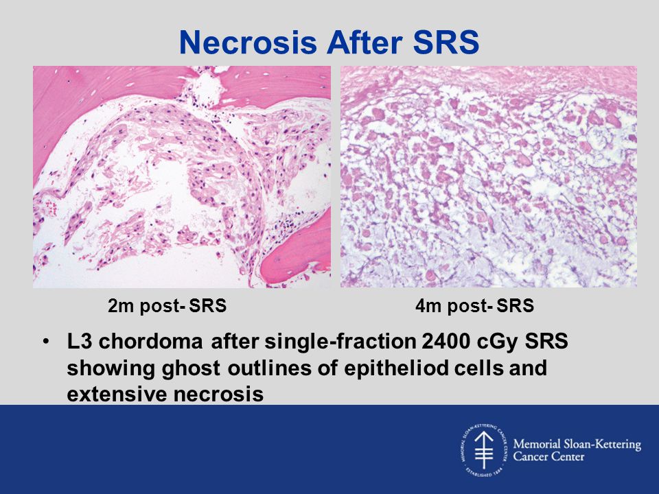 Necrosis After SRS 2m post- SRS. 4m post- SRS.