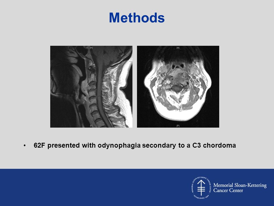 Methods 62F presented with odynophagia secondary to a C3 chordoma