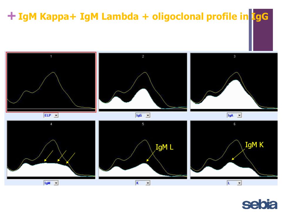Serum Protein Electrophoresis with Immunofixation - ppt video online  download