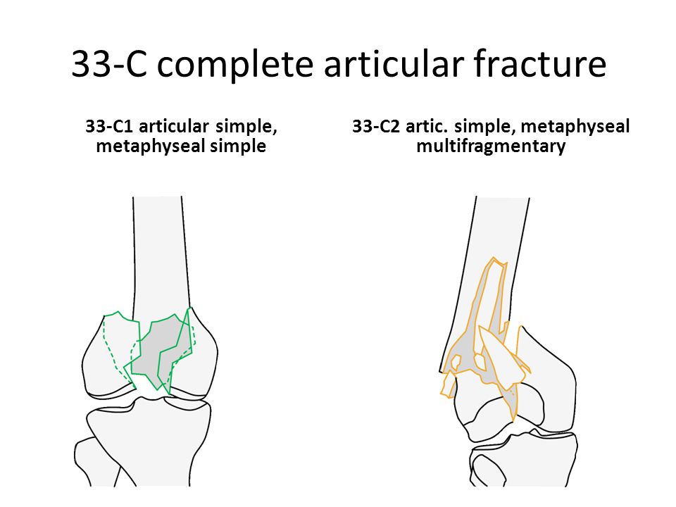 complete articular fracture