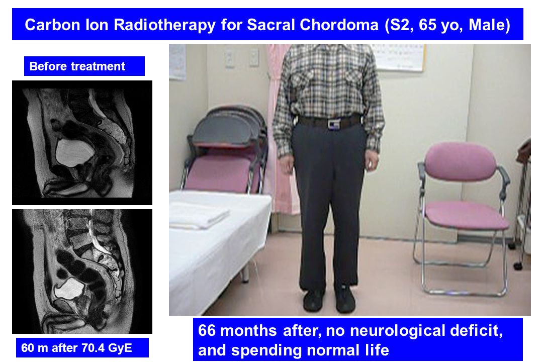 Carbon Ion Radiotherapy for Sacral Chordoma (S2, 65 yo, Male)