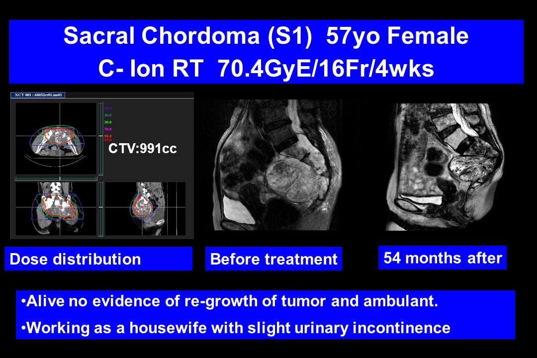 Sacral Chordoma (S1) 57yo Female C- Ion RT 70.4GyE/16Fr/4wks