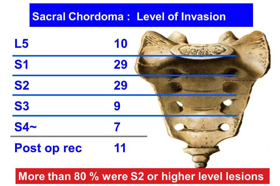Sacral Chordoma : Level of Invasion