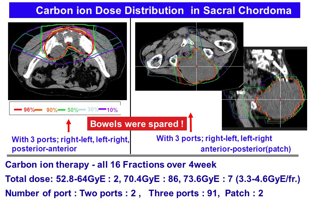 Carbon ion Dose Distribution in Sacral Chordoma