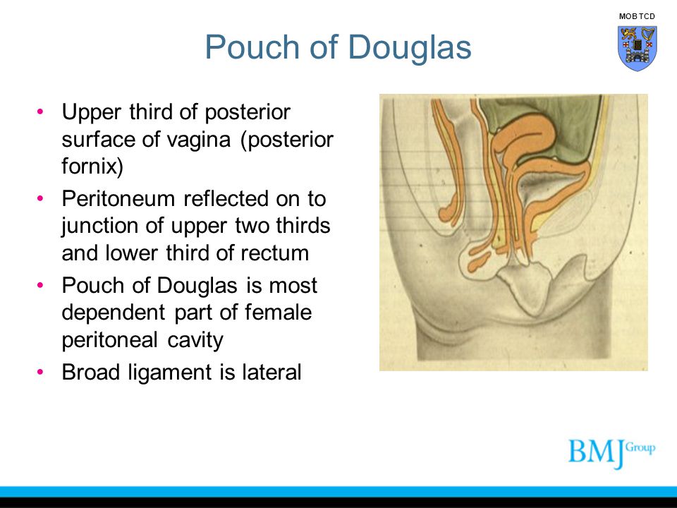 Pouch of Douglas MOB TCD. Upper third of posterior surface of vagina (posterior fornix)
