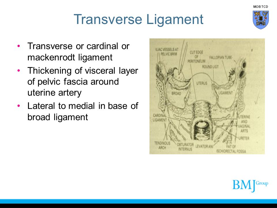 Transverse Ligament Transverse or cardinal or mackenrodt ligament