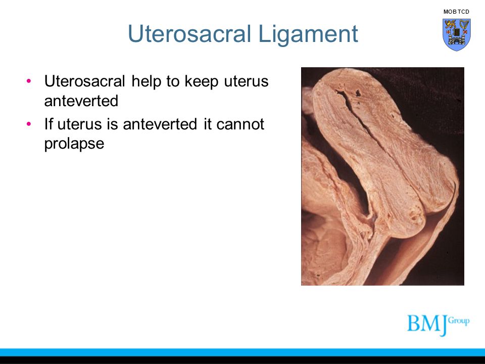 Uterosacral Ligament Uterosacral help to keep uterus anteverted