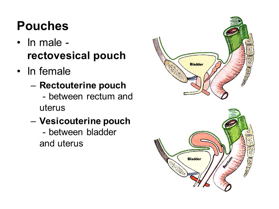 Pouches In male－rectovesical pouch In female.