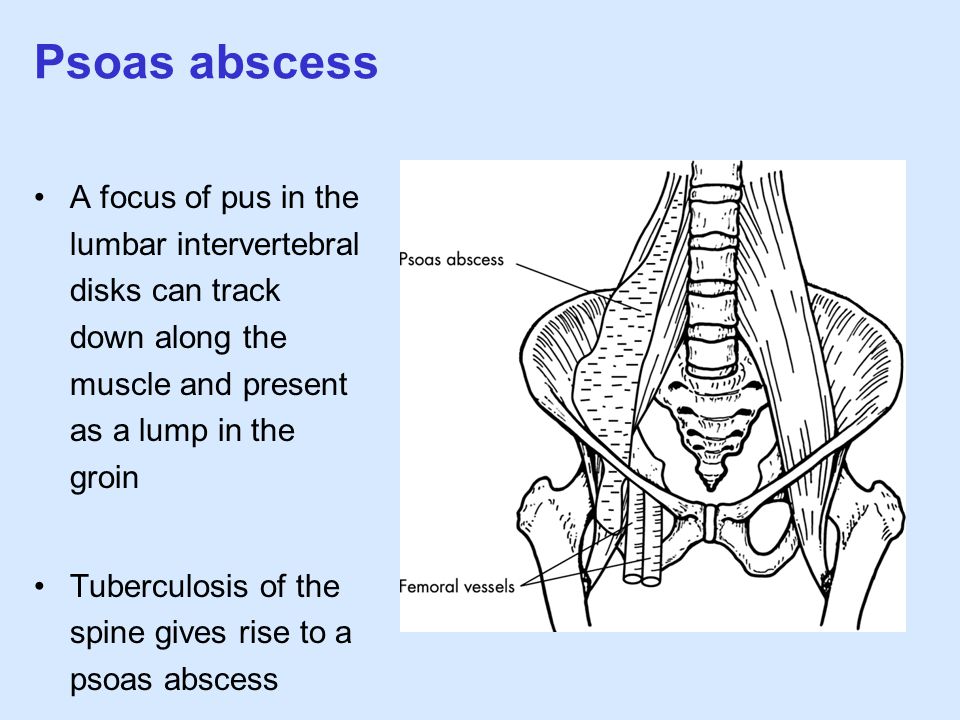 Psoas abscess A focus of pus in the lumbar intervertebral disks can track down along the muscle and present as a lump in the groin.