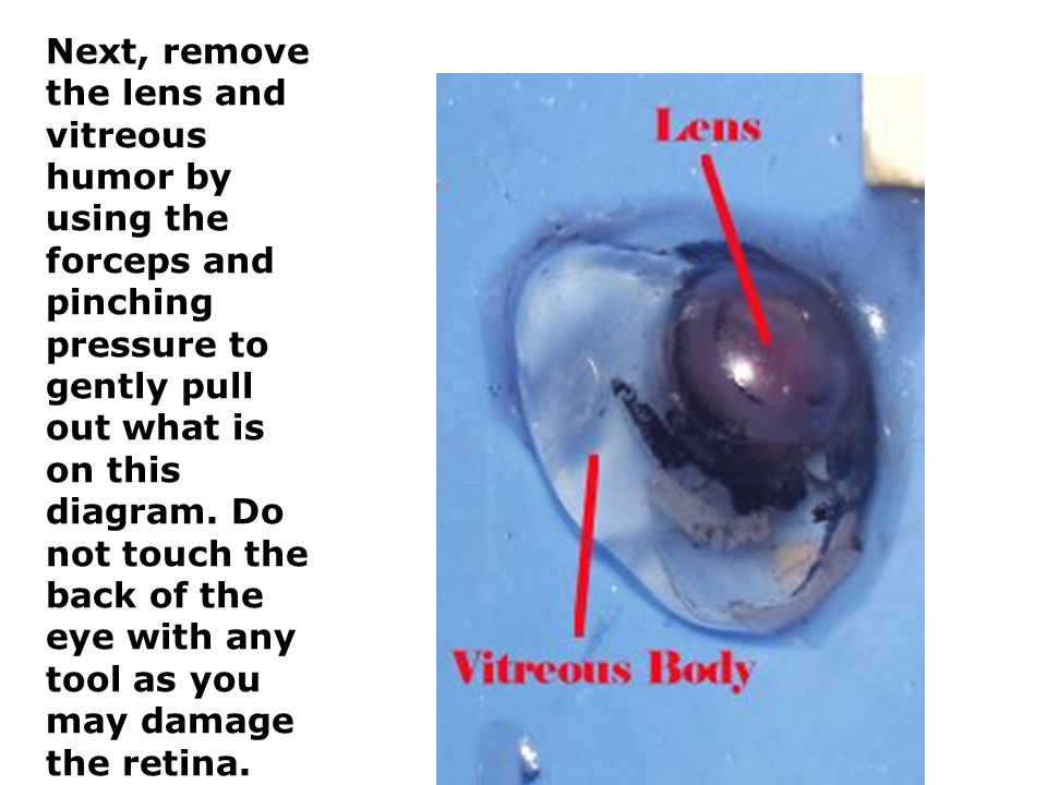 Next, remove the lens and vitreous humor by using the forceps and pinching pressure to gently pull out what is on this diagram.