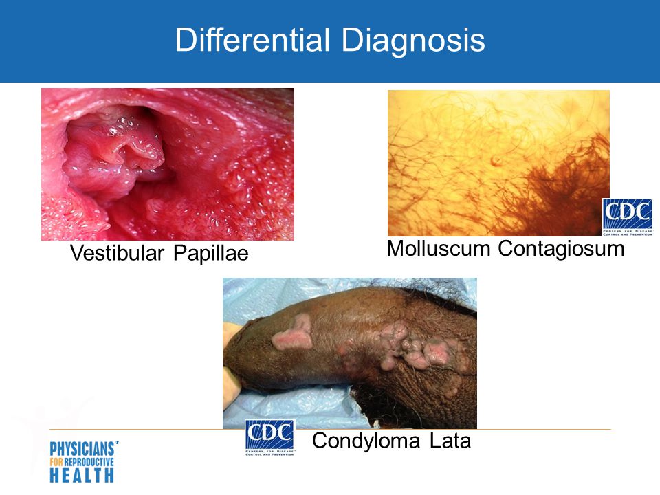 Papilloma vs condyloma. synlab: Cancerul de col uterin