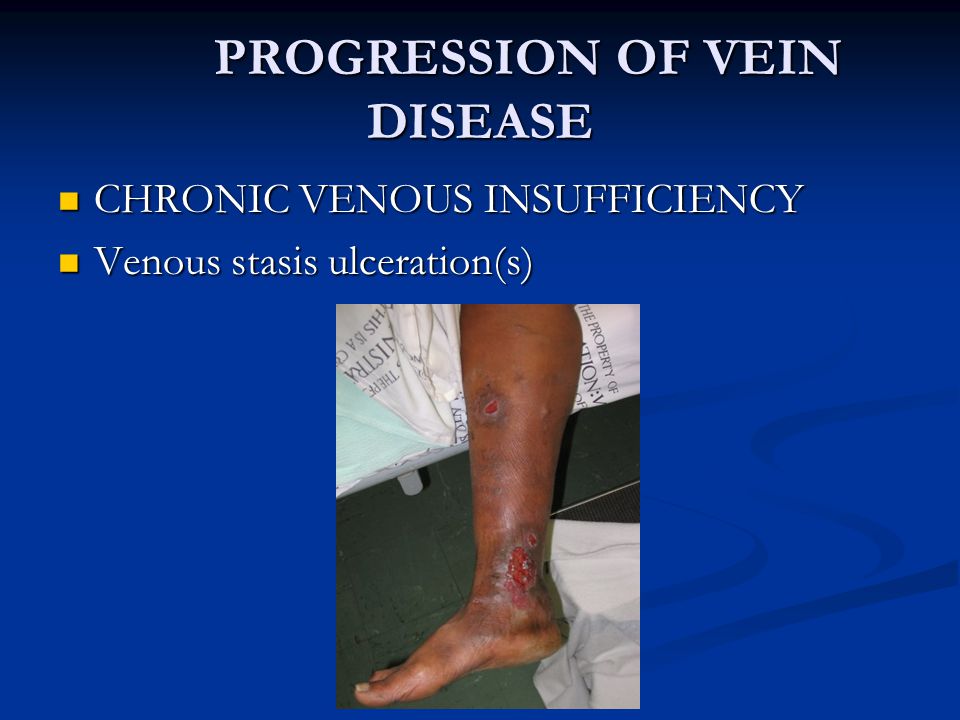 Venous Insufficiency, Venous Stasis