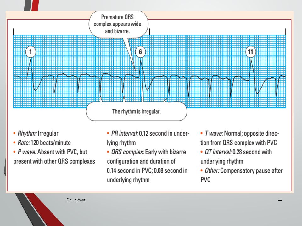 ECG in Ventricular arrhythmias - ppt video online download