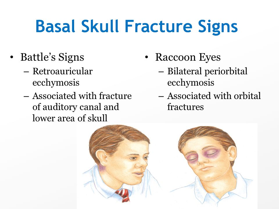 Of skull fracture basilar signs Basilar Skull