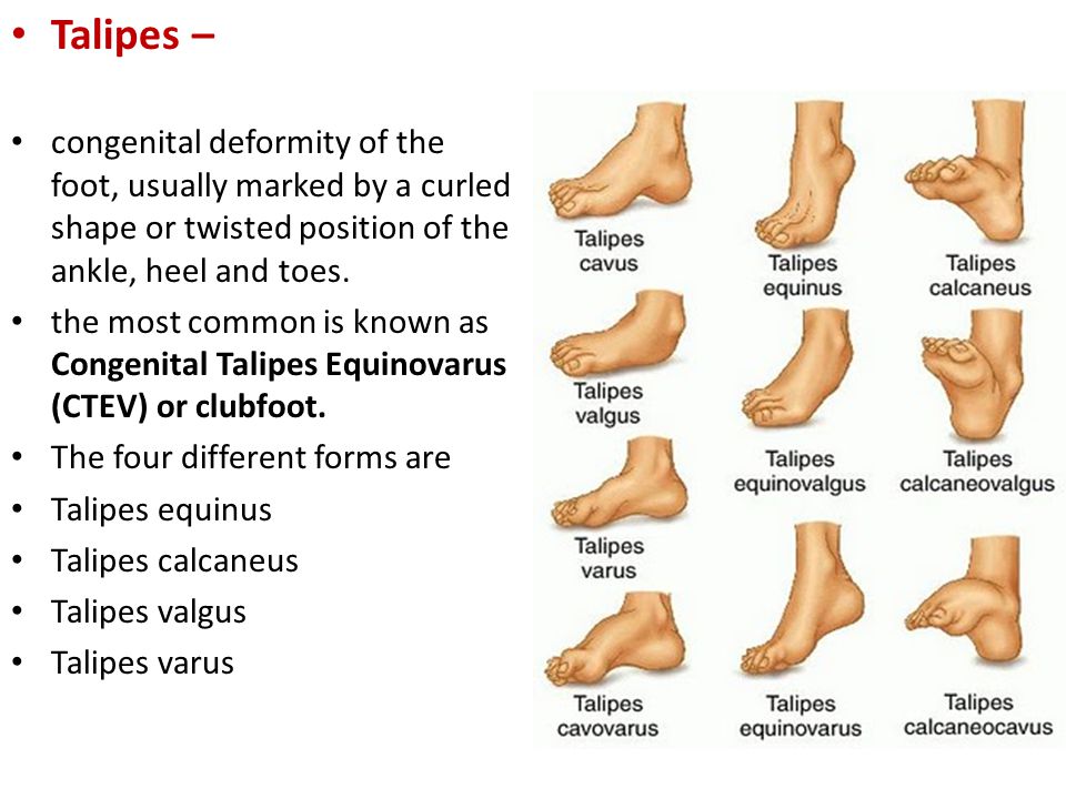 Foot And Arches Of The Foot Ppt Video Online Download