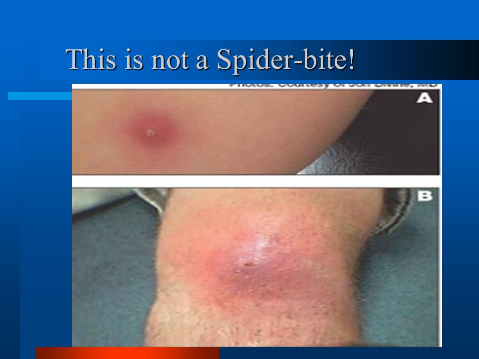 What is the Difference Between Spider Bite and Staph Infection