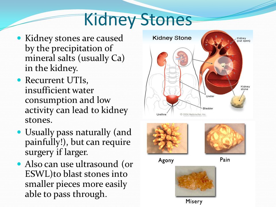 Frequent Uti Kidney Stones لم يسبق له مثيل الصور Tier3 Xyz