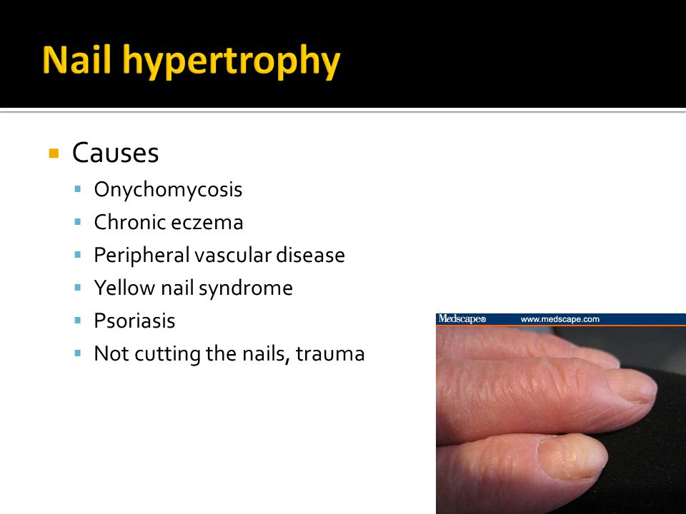 Nail+hypertrophy+Causes+Onychomycosis+Chronic+eczema