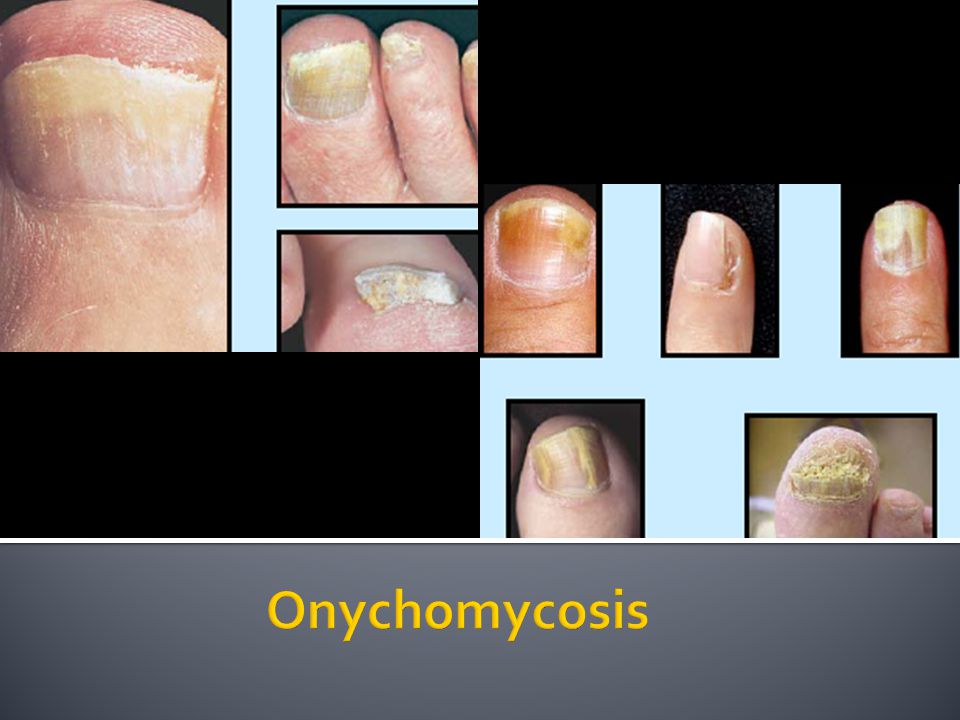 CSPA - Nails - Other Disorders