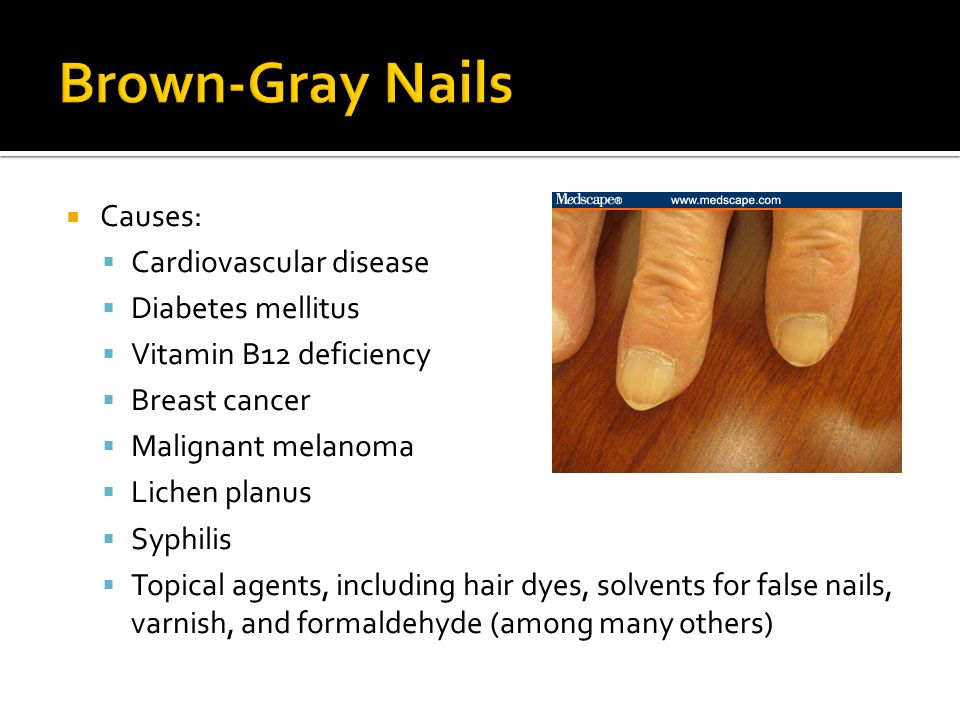 Brown Gray+Nails+Causes%3A+Cardiovascular+disease+Diabetes+mellitus