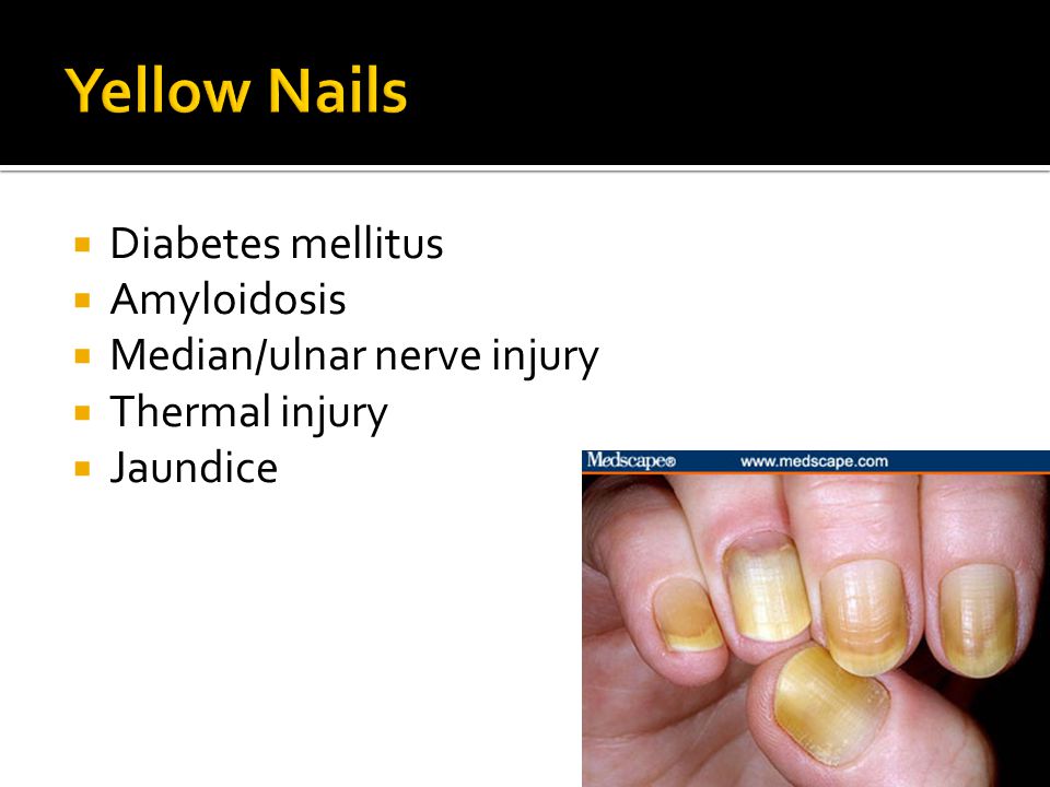Yellow+Nails+Diabetes+mellitus+Amyloidosis+Median%2Fulnar+nerve+injury