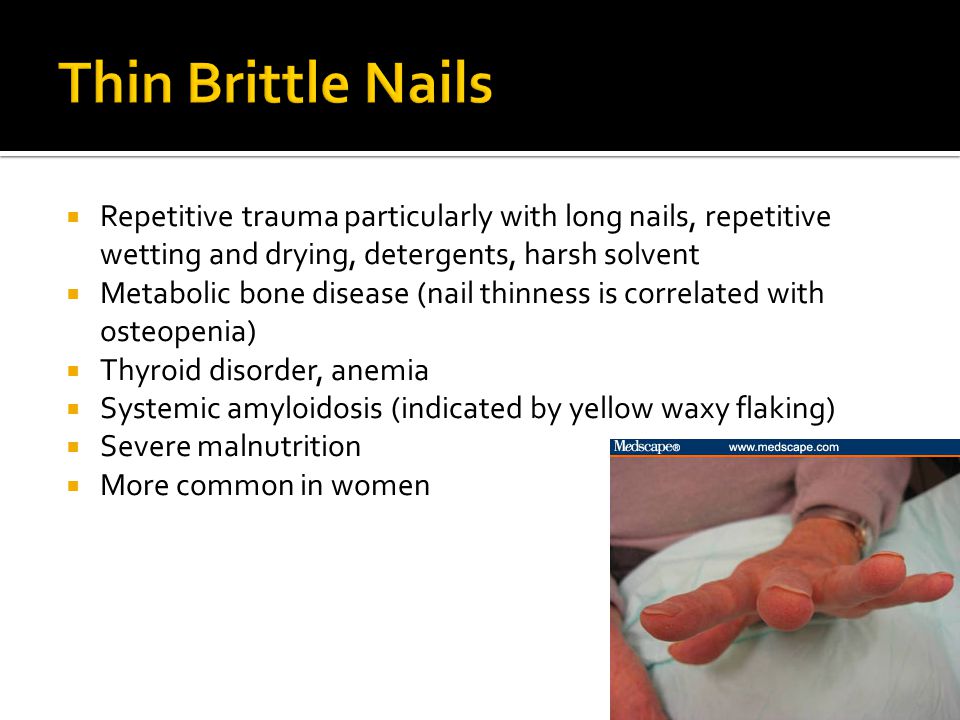 Nail clubbing causes, symptoms & nail clubbing treatment