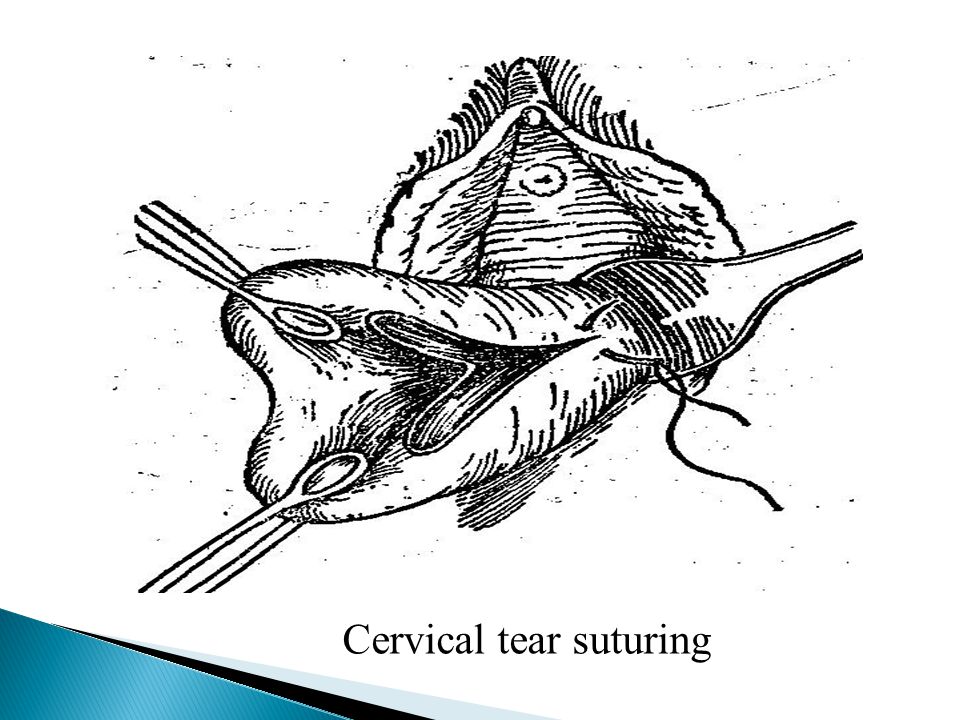 Cervical tear suturing