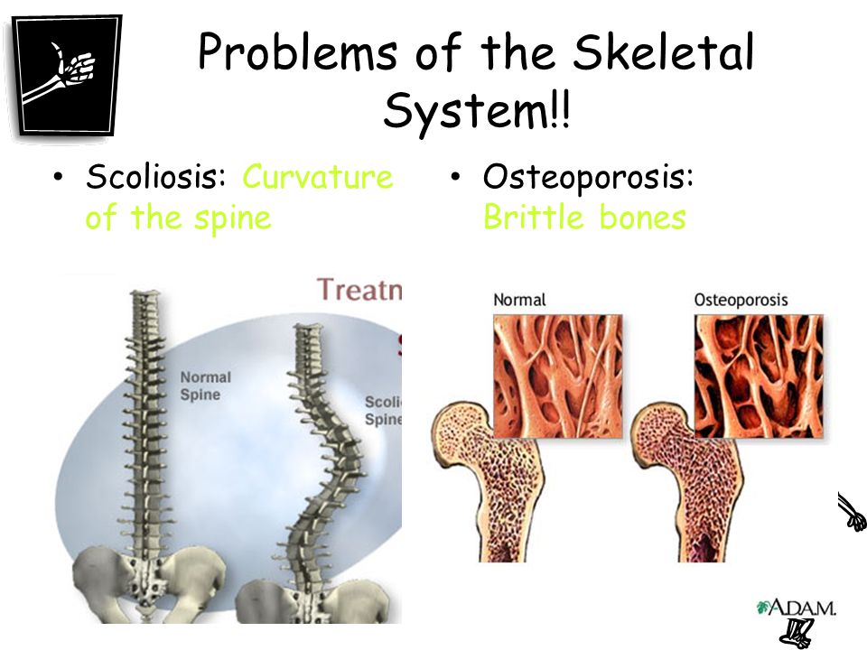 Problems of the Skeletal System!!