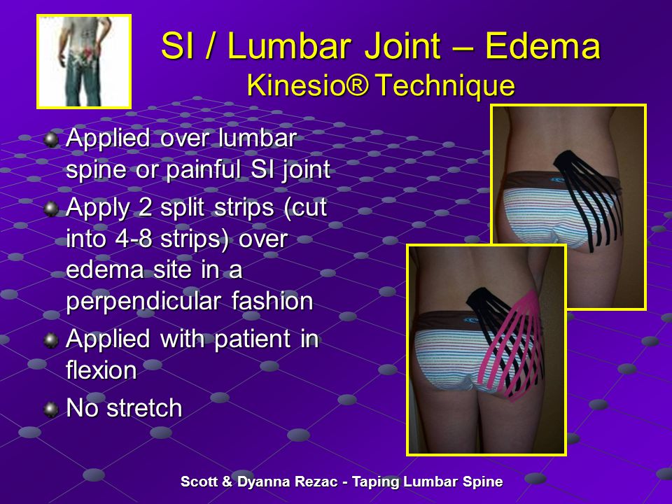 Therapeutic Taping for the Lumbar Spine and Pelvis - ppt video online  download