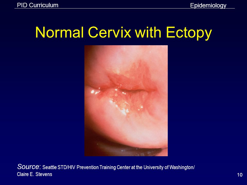 Normal Cervix with Ectopy.